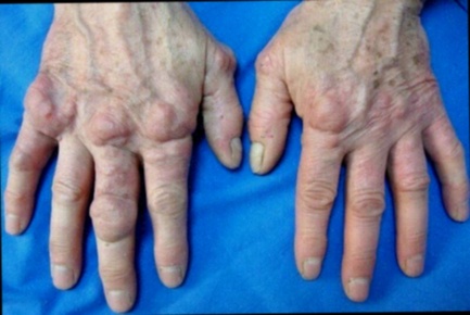 Achat pommade anti-inflammatoire arthrose
