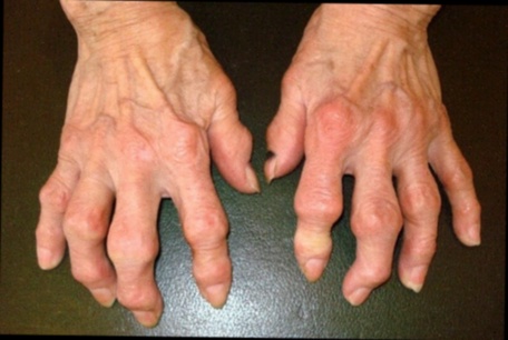 Cartiregen Arthrose