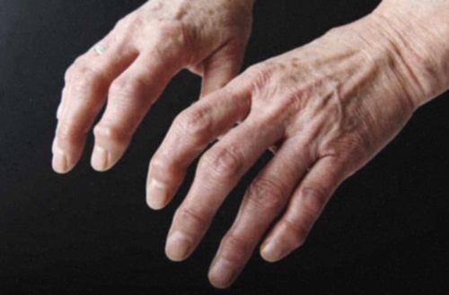 Chondraflex Arthrose