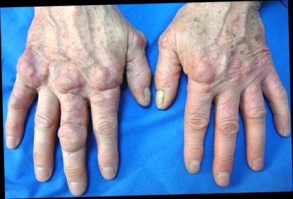 Remède grand-mère pour douleur hanche