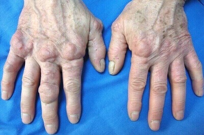 Anti-inflammatoire naturel articulations